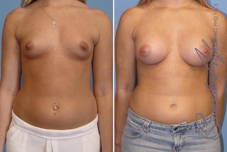 Breast Augmentation Before & After
