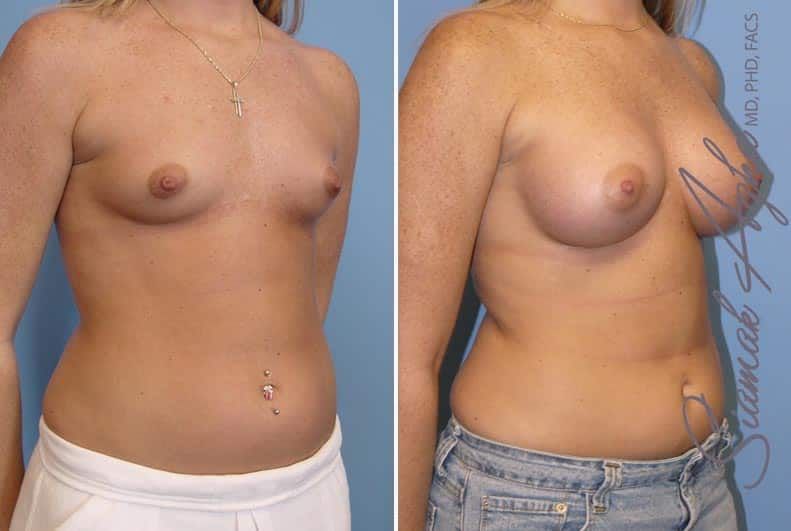 Breast Augmentation Before & After