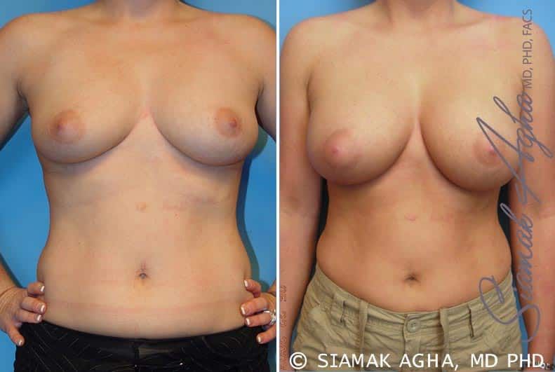 Breast Augmentation Before & After