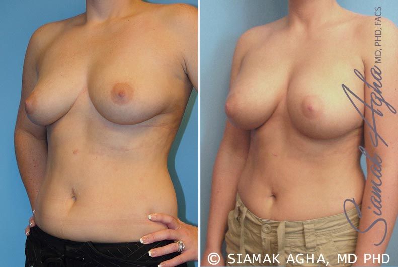 Breast Augmentation Before & After
