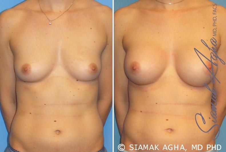 Breast Augmentation Before & After