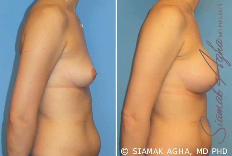 Breast Augmentation Before & After