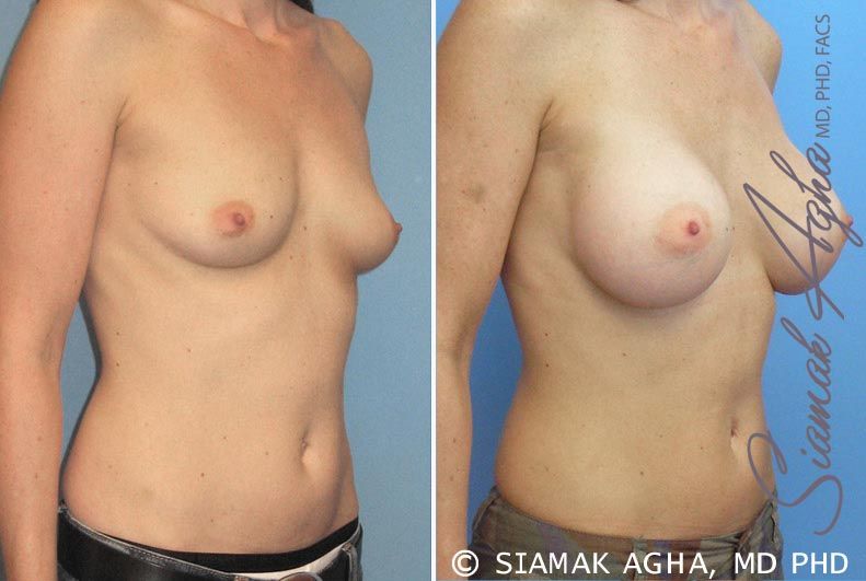 Breast Augmentation Before & After