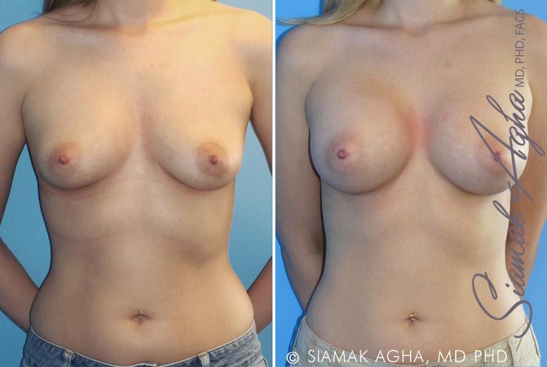 Breast Augmentation Before & After