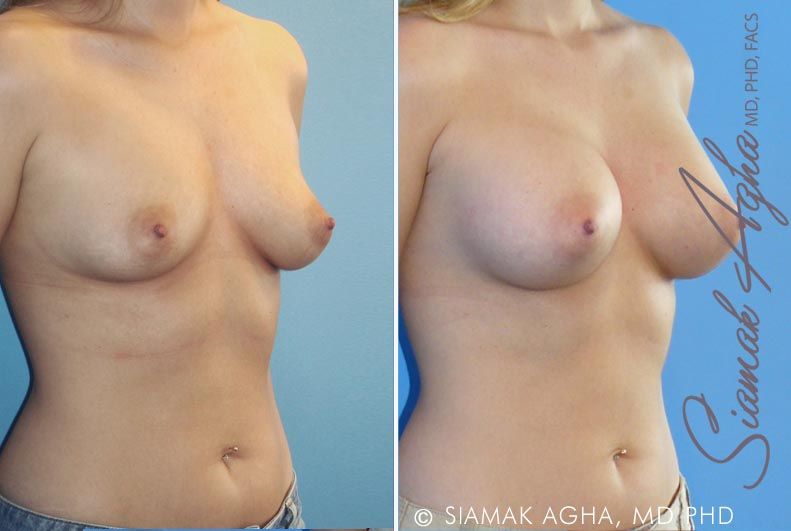 Breast Augmentation Before & After