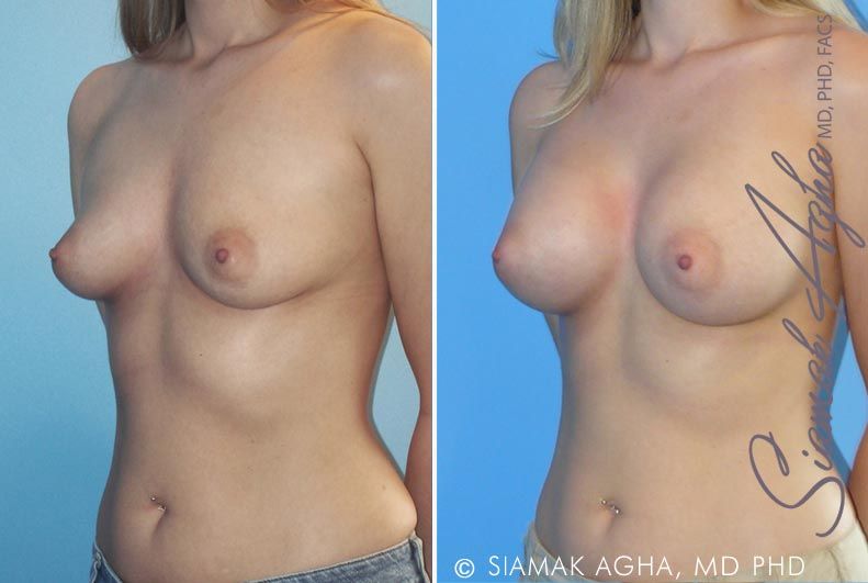 Breast Augmentation Before & After