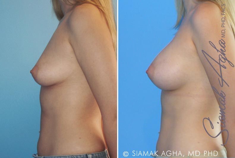 Breast Augmentation Before & After