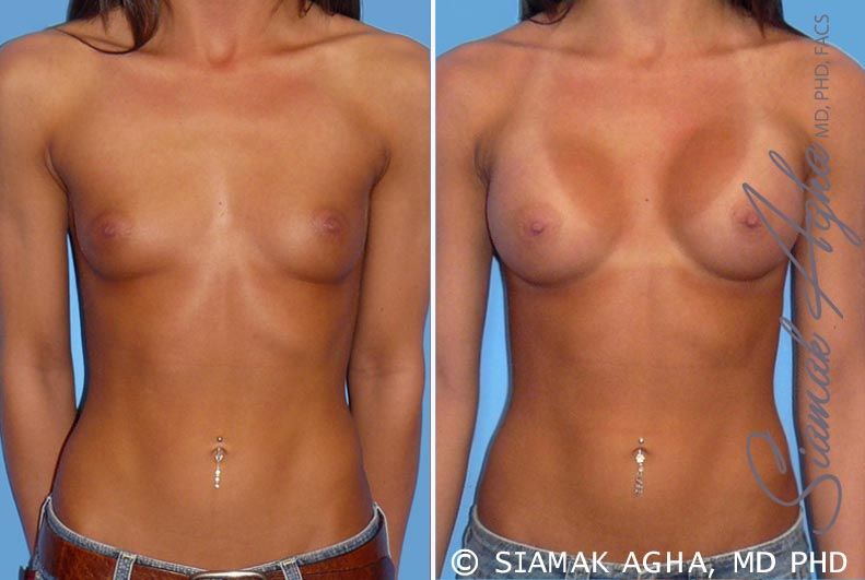 Breast Augmentation Before & After