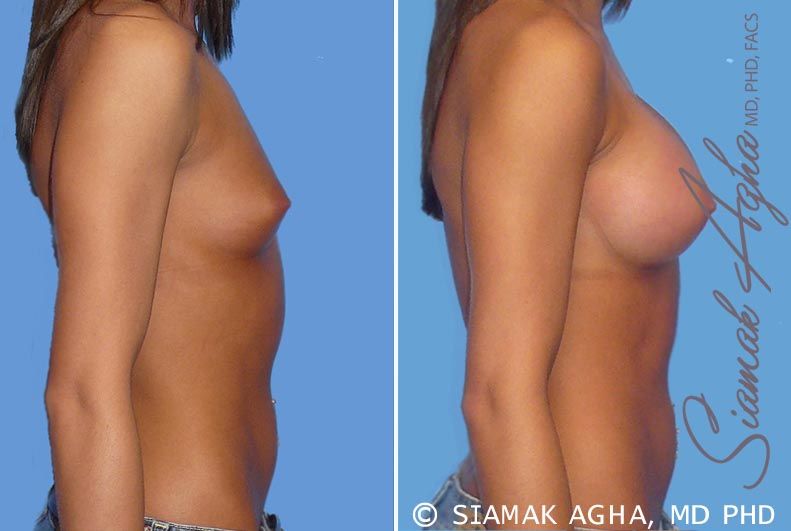 Breast Augmentation Before & After