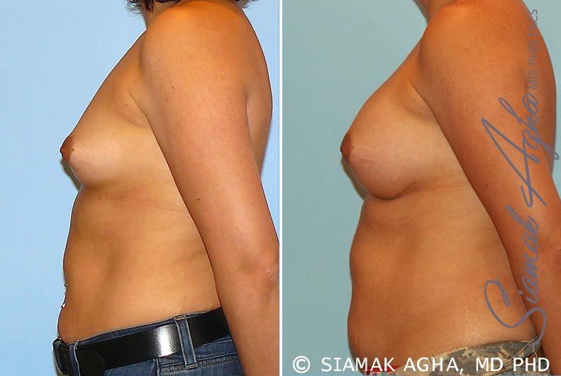 Breast Augmentation Before & After