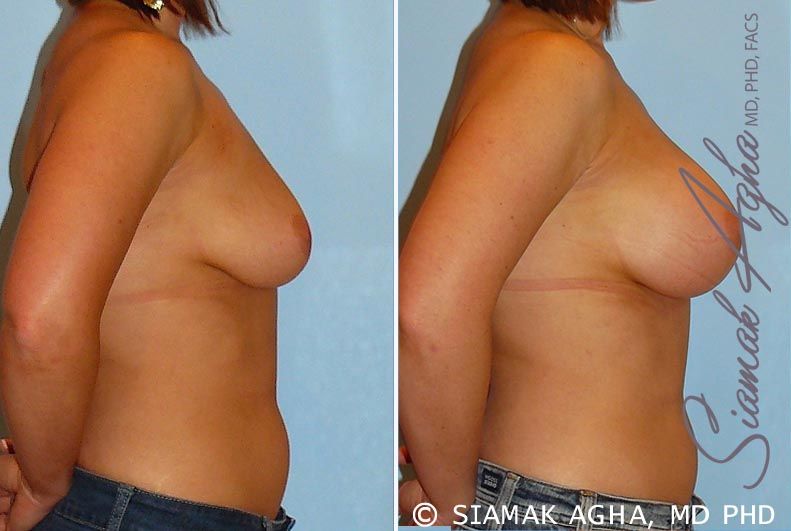 Breast Augmentation Before & After