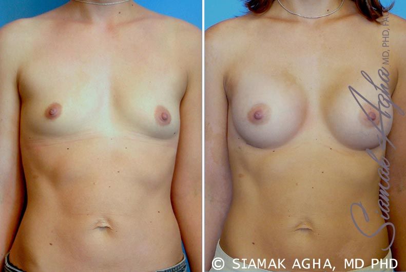 Breast Augmentation Before & After