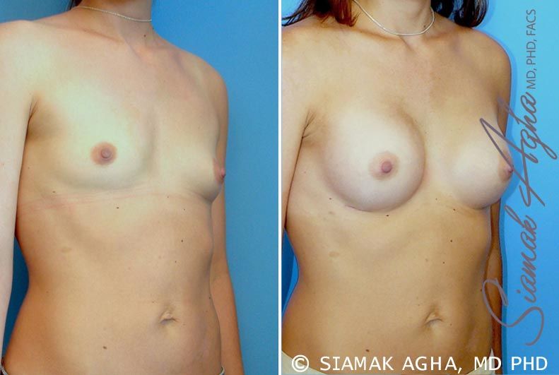 Breast Augmentation Before & After