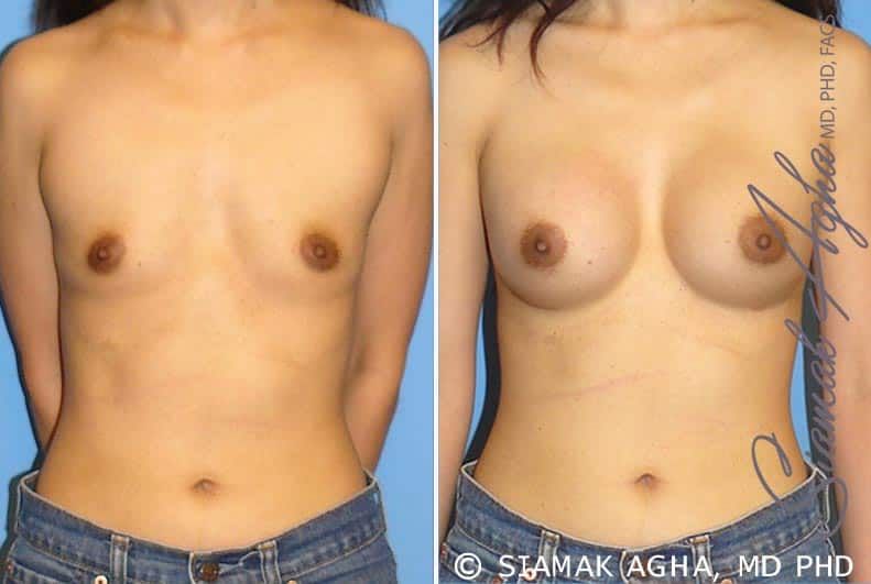 Breast Augmentation Before & After