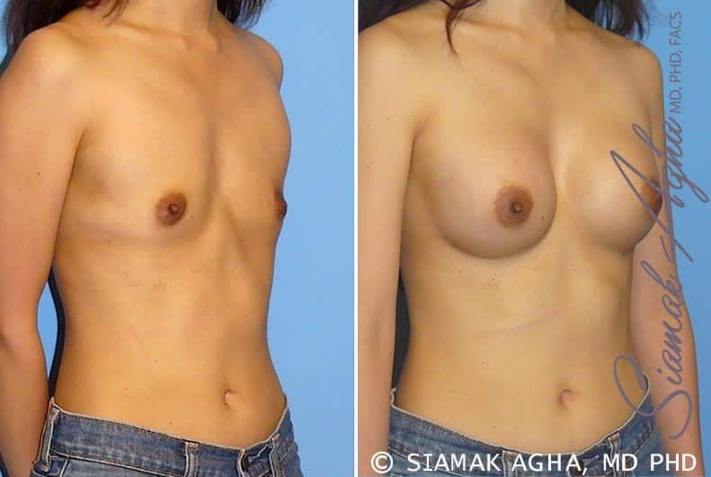 Breast Augmentation Before & After