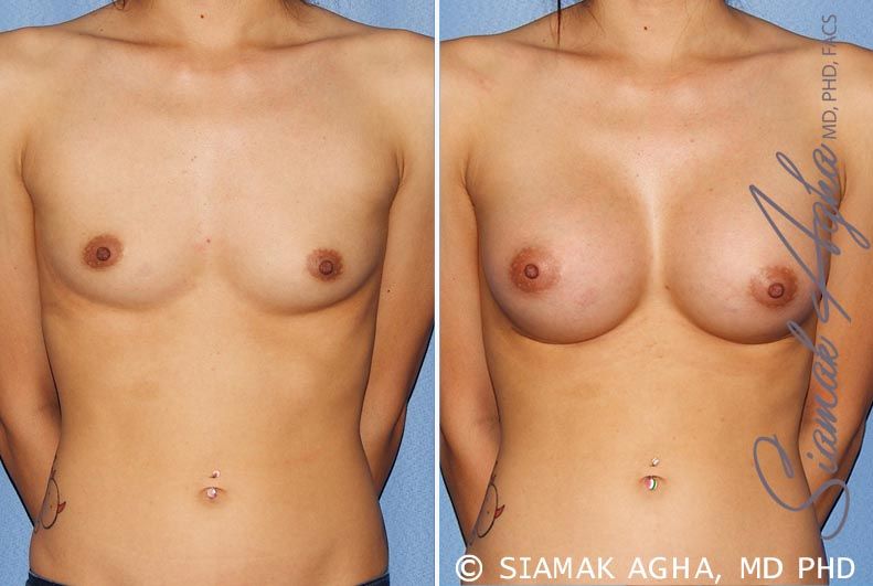 Breast Augmentation Before & After