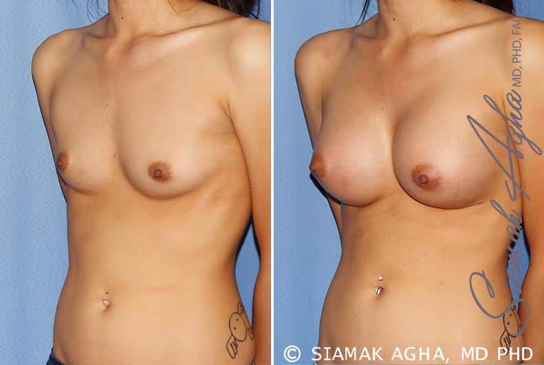 Breast Augmentation Before & After