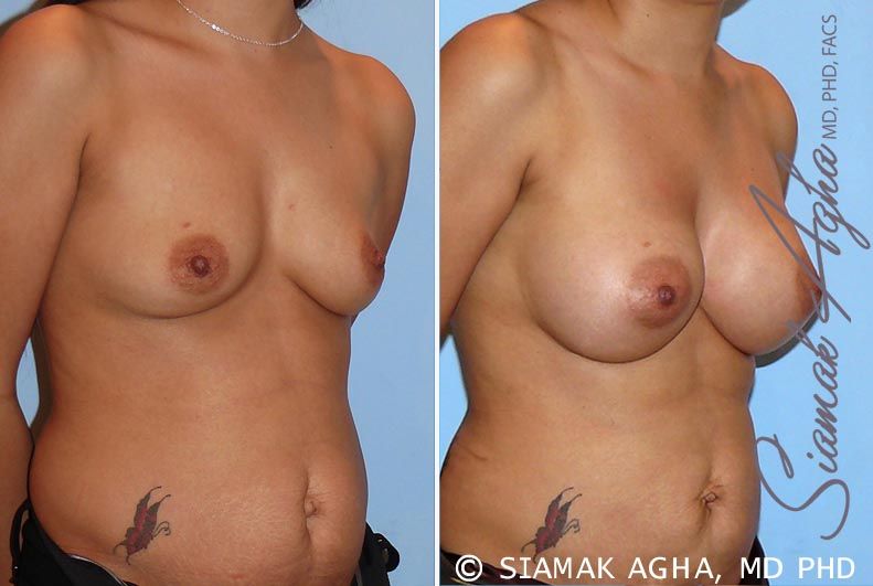 Breast Augmentation Before & After