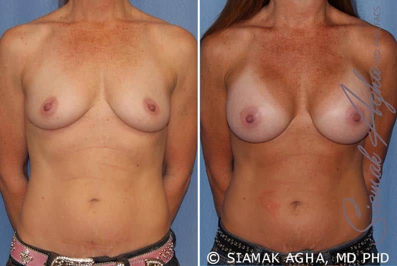 Breast Augmentation Before & After