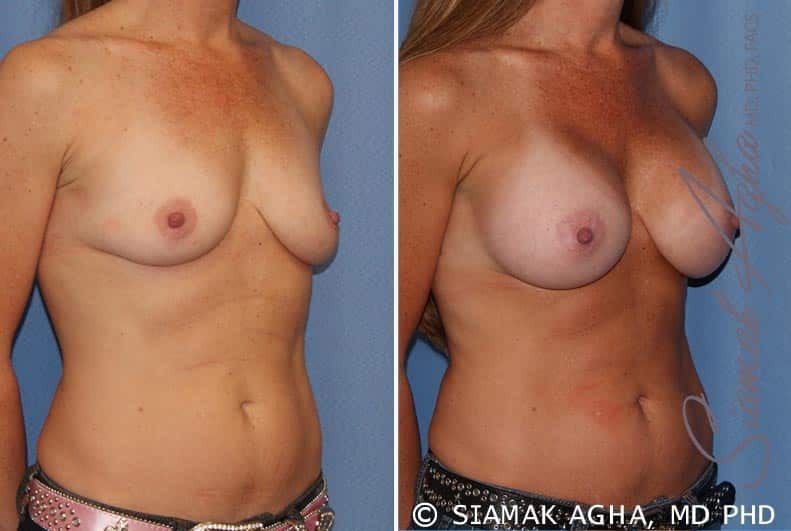 Breast Augmentation Before & After