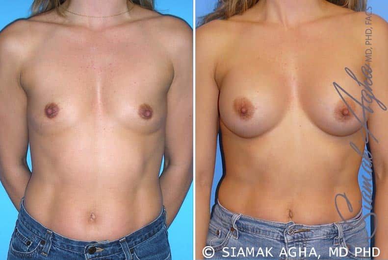 Breast Augmentation Before & After