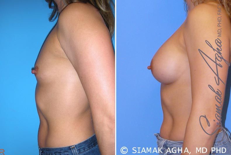 Breast Augmentation Before & After