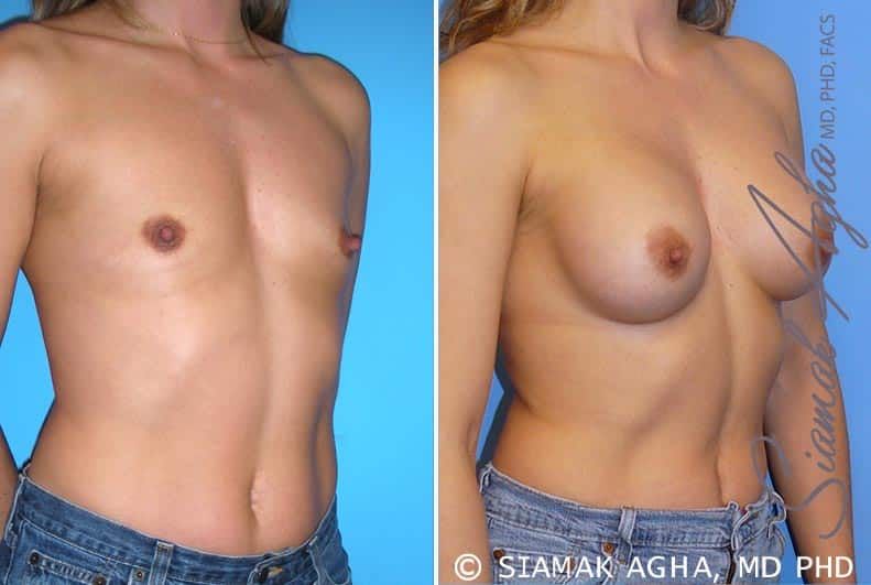 Breast Augmentation Before & After