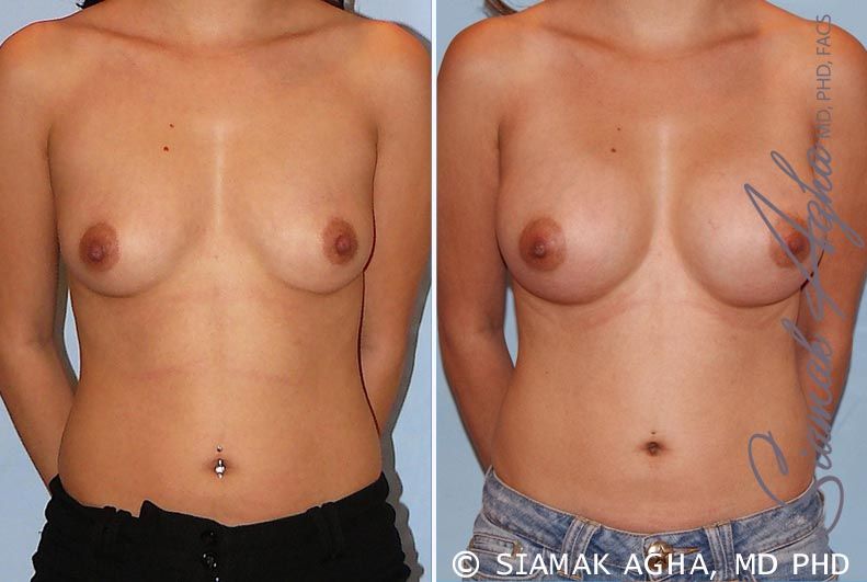 Breast Augmentation Before & After