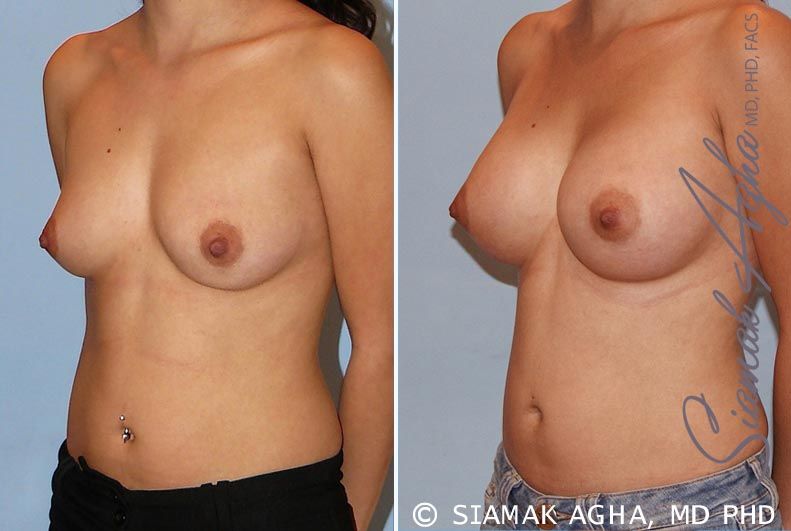 Breast Augmentation Before & After