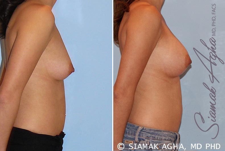Breast Augmentation Before & After