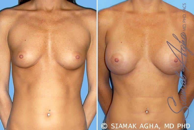 Breast Augmentation Before & After