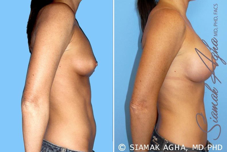 Breast Augmentation Before & After