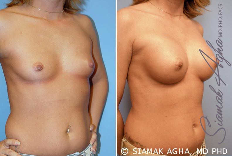 Breast Augmentation Before & After