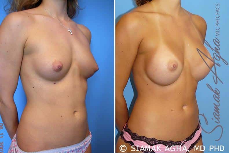 Breast Augmentation Before & After
