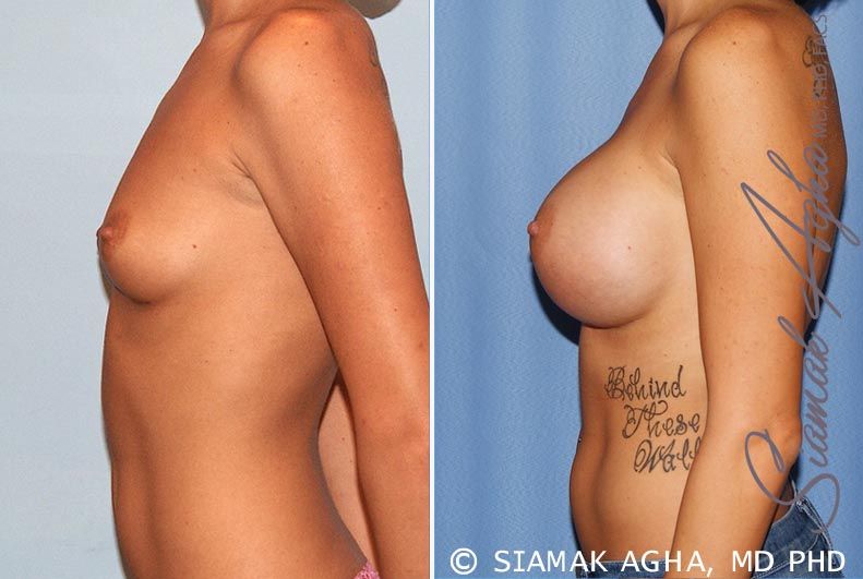 Breast Augmentation Before & After
