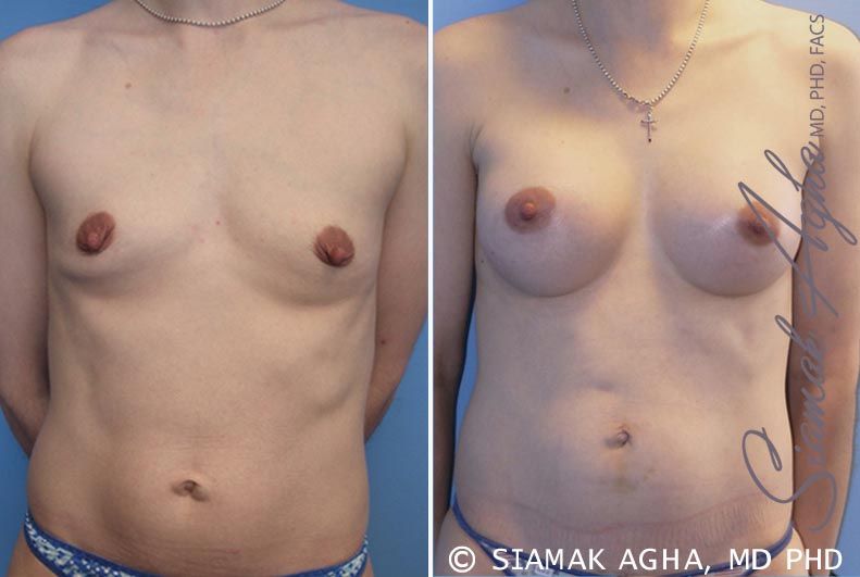 Breast Augmentation Before & After