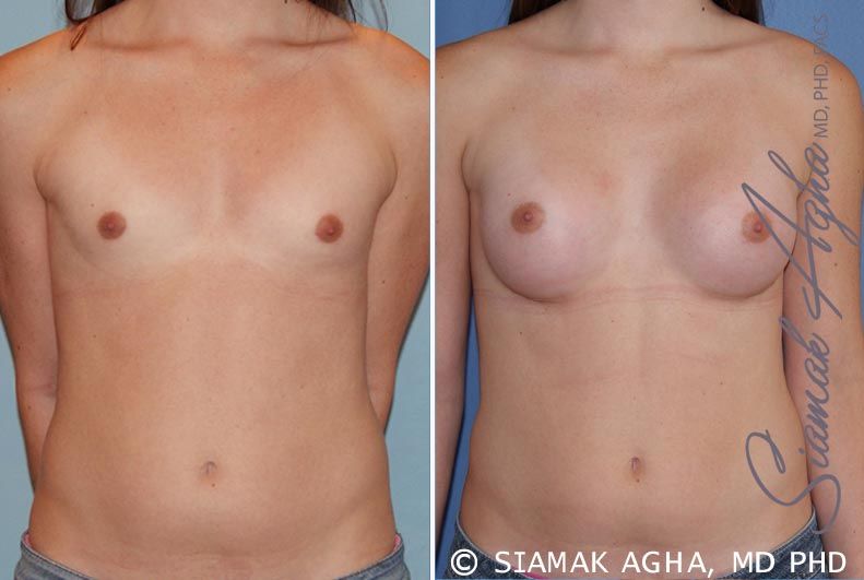 Breast Augmentation Before & After