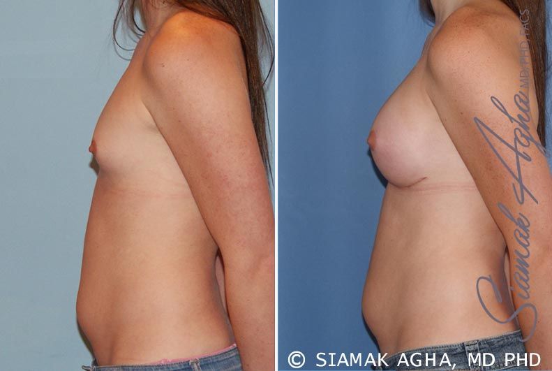 Breast Augmentation Before & After