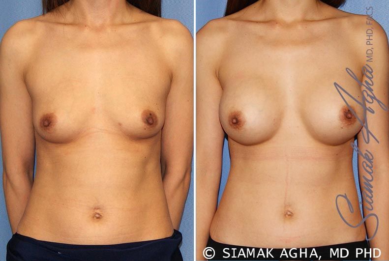 Breast Augmentation Before & After