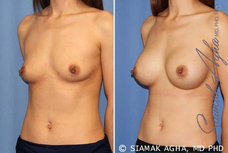 Breast Augmentation Before & After