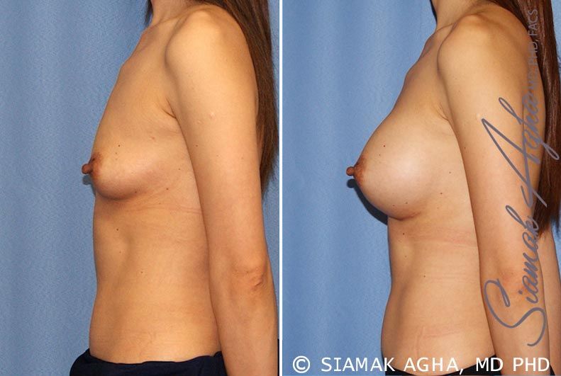 Breast Augmentation Before & After