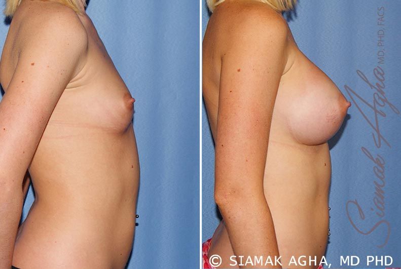 Breast Augmentation Before & After