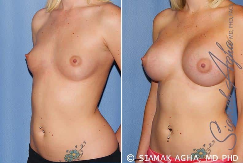 Breast Augmentation Before & After
