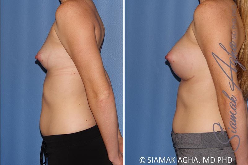 Breast Augmentation Before & After