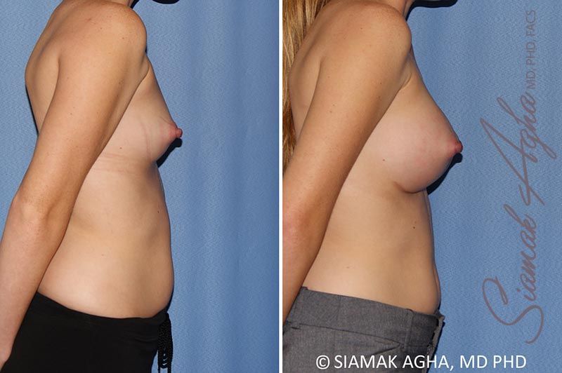 Breast Augmentation Before & After