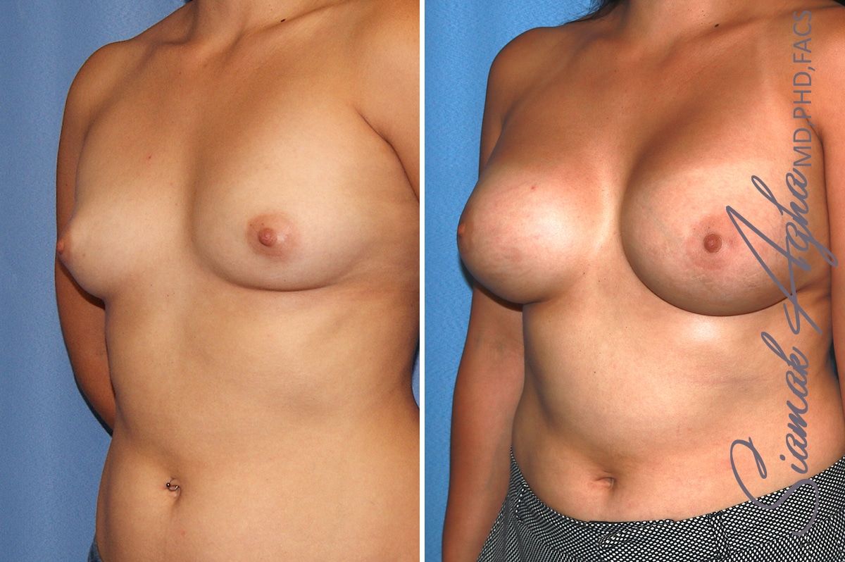 Breast Augmentation Before & After