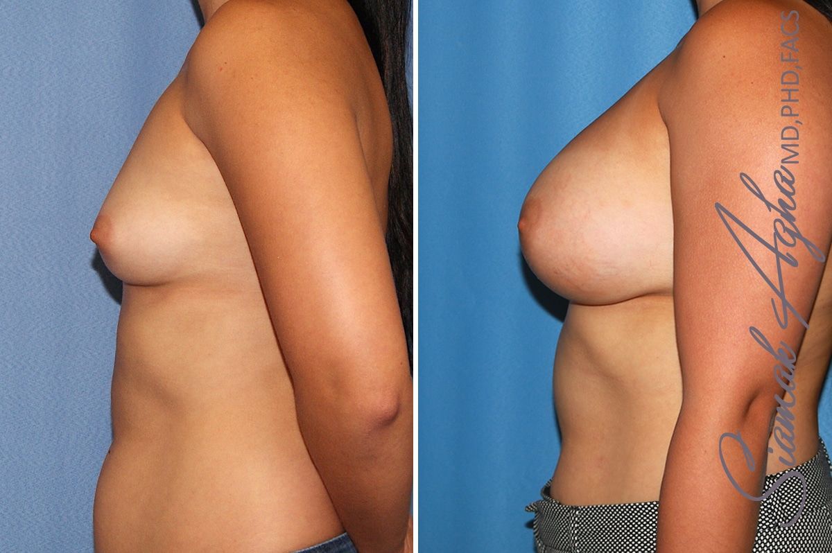 Breast Augmentation Before & After