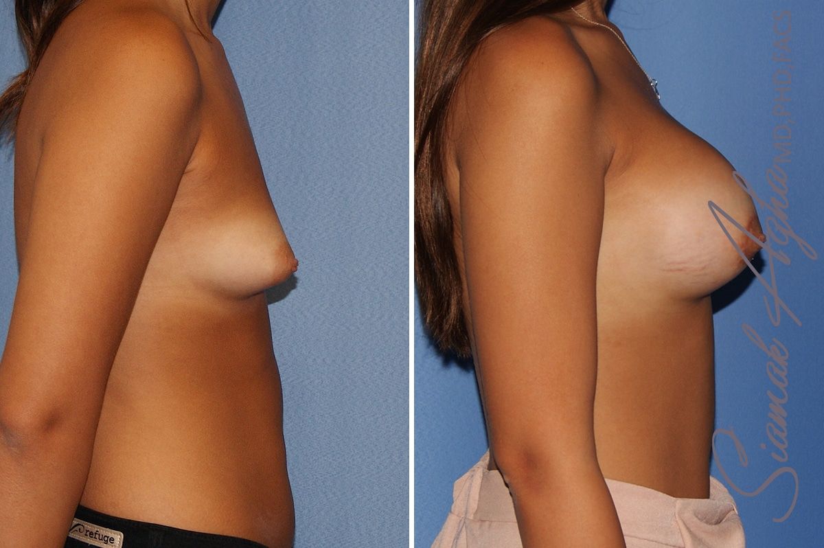 Breast Augmentation Before & After