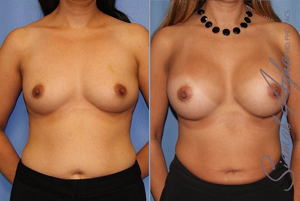 Breast Augmentation Before & After