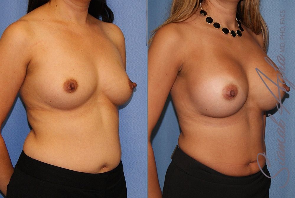 Breast Augmentation Before & After